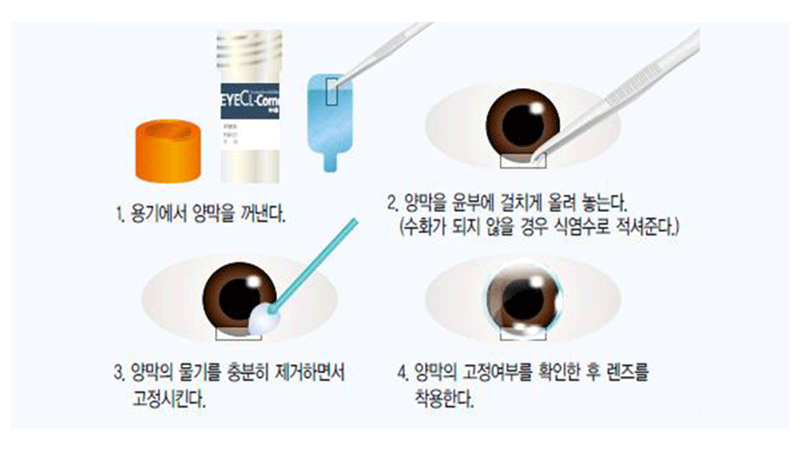 cornea 양막이미지
