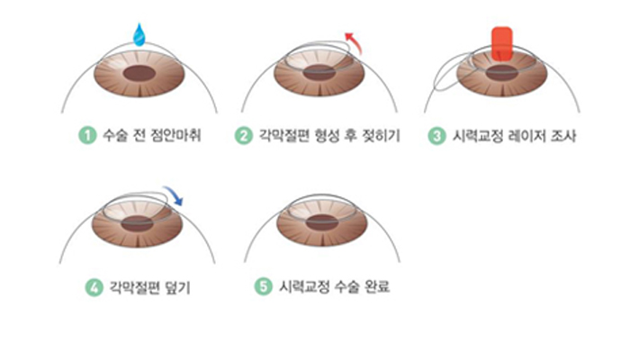 라식 이미지