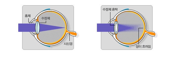 라식 이미지