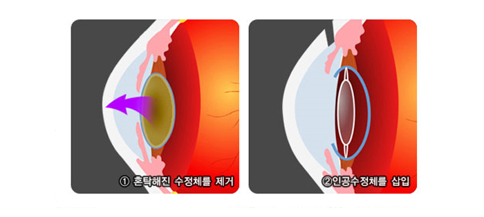 백내장수술