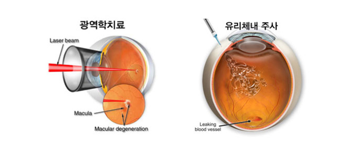 황반변성치료