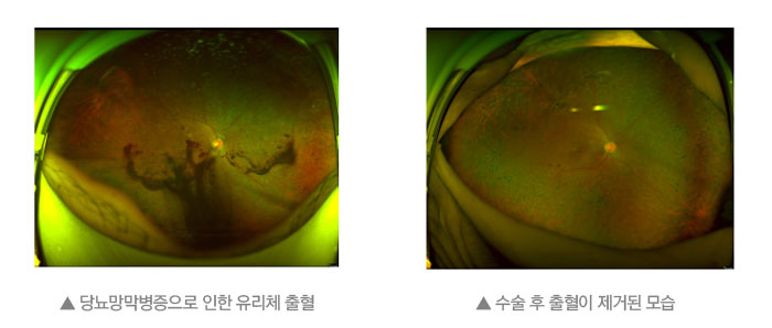 당뇨 막막병증