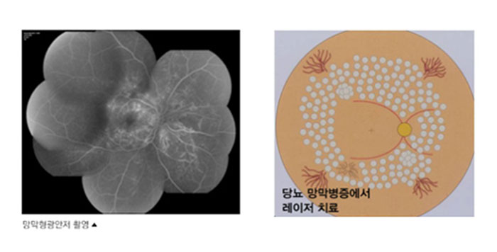 당뇨 막막병증