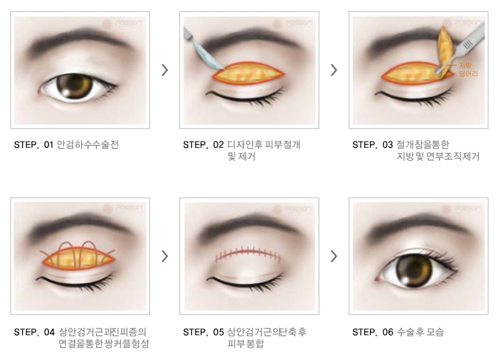안검하수수술